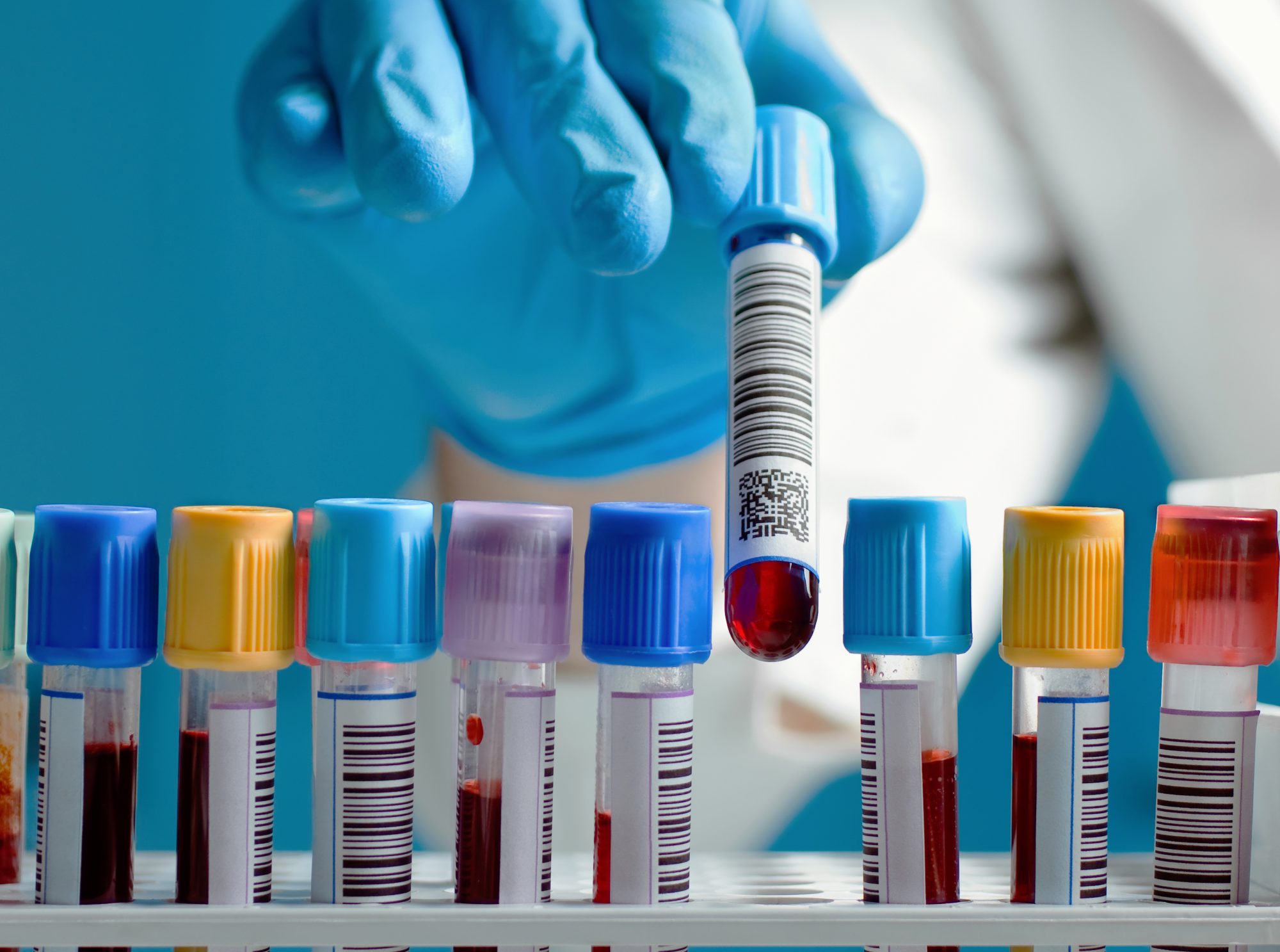 blood test vials in a holder with a lab technician placing an additional vial into the tray